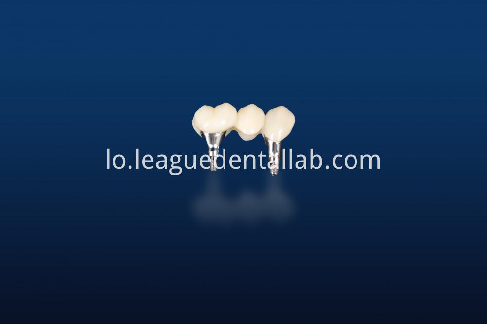 Dental Implant Crown, Dental Implant Zirconia crown,Dental Implant Emax crown,Dental Implant Bridge